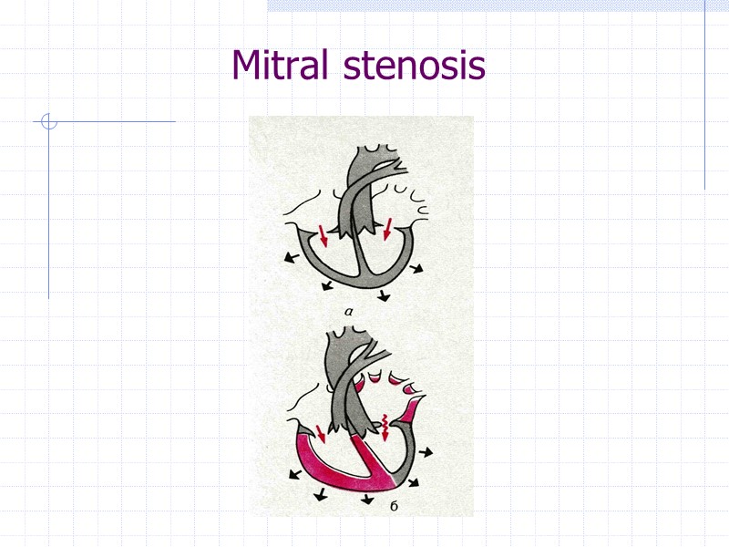 Mitral stenosis